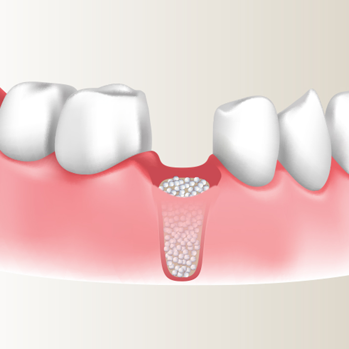 bone grafting diagram