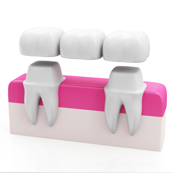tooth bridge
