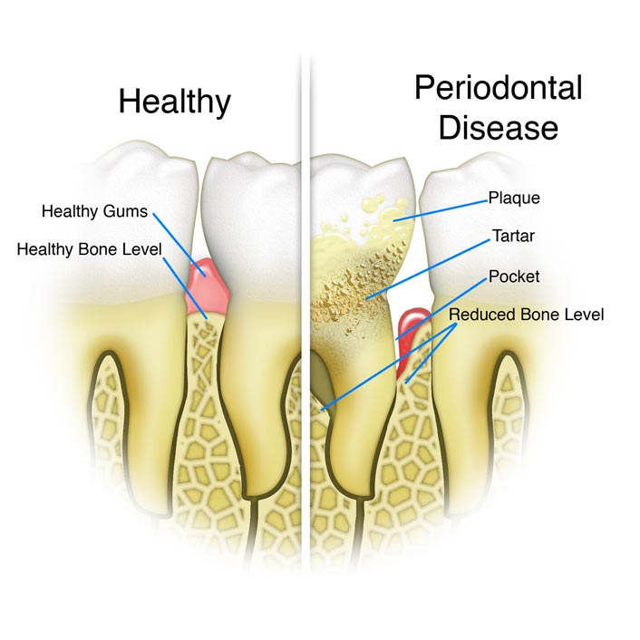 periodontal disease