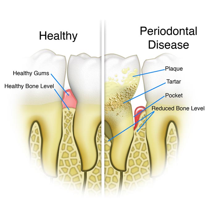 periodontal disease