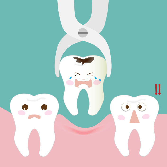 tooth extraction