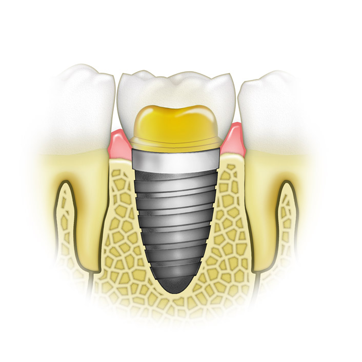 tooth implant