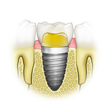 tooth implant