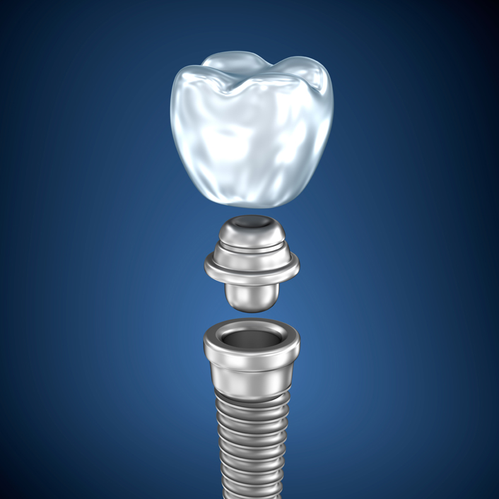 dental implant diagram