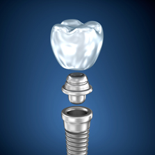 dental implant diagram