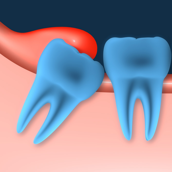 wisdom teeth